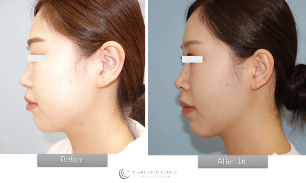脂肪吸引 頬 フェイスライン 顎下 パールスキンクリニック天神 院長ブログ