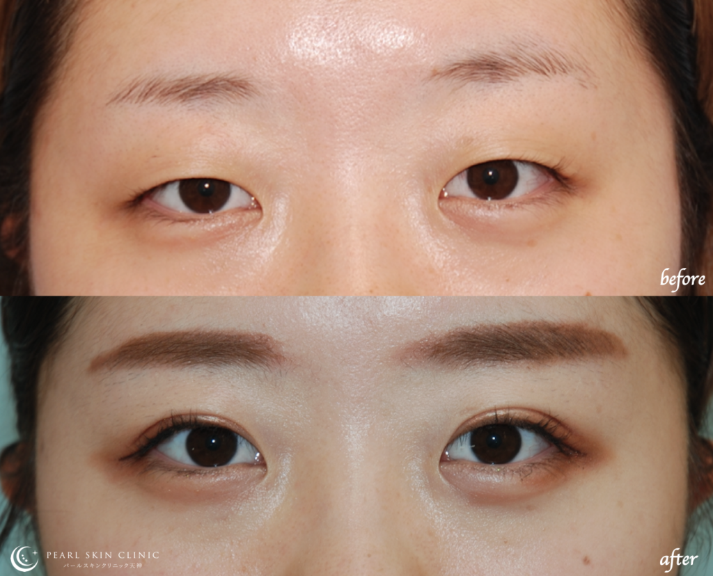 埋没法の選び方：2点留め、4点留め、6点留め – パールスキンクリニック  