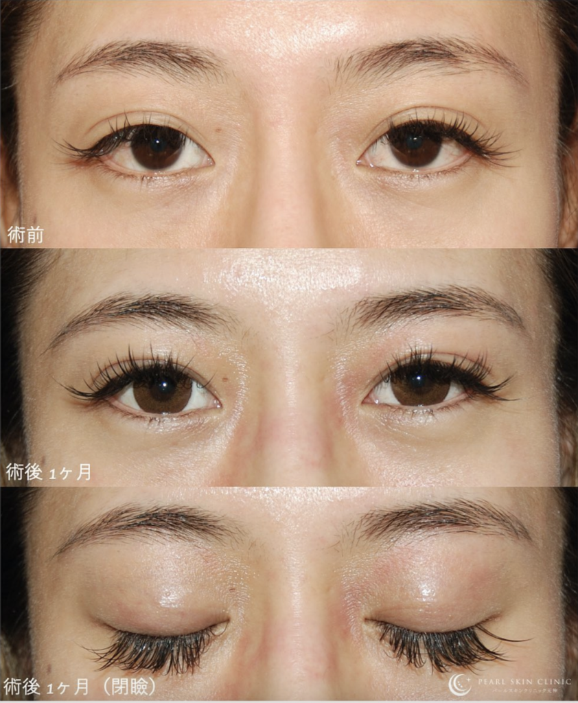 埋没法の選び方：2点留め、4点留め、6点留め – パールスキンクリニック  