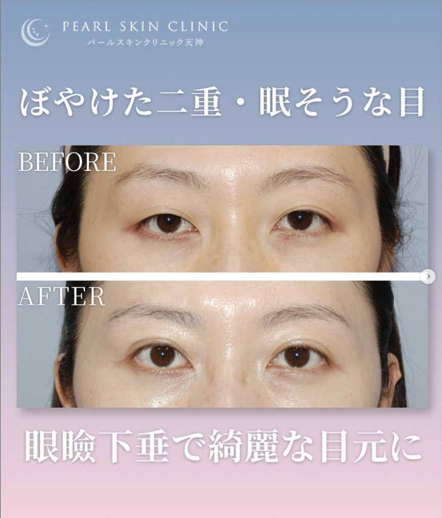 目元 眼瞼下垂 眠たそうな目を明るく綺麗な目元に – パールスキンクリニック天神 院長ブログ