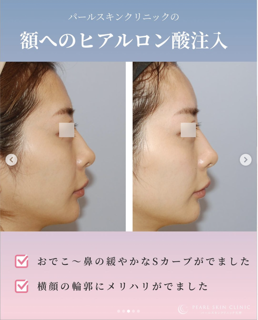 輪郭 – ページ 2 – パールスキンクリニック天神 院長ブログ