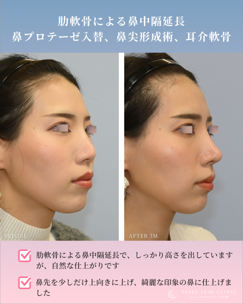 綺麗な鼻腔 鼻プロテーゼ入替、肋軟骨での鼻中隔延長、鼻尖形成術、耳介軟骨移植（他院修正） – パールスキンクリニック天神 院長ブログ