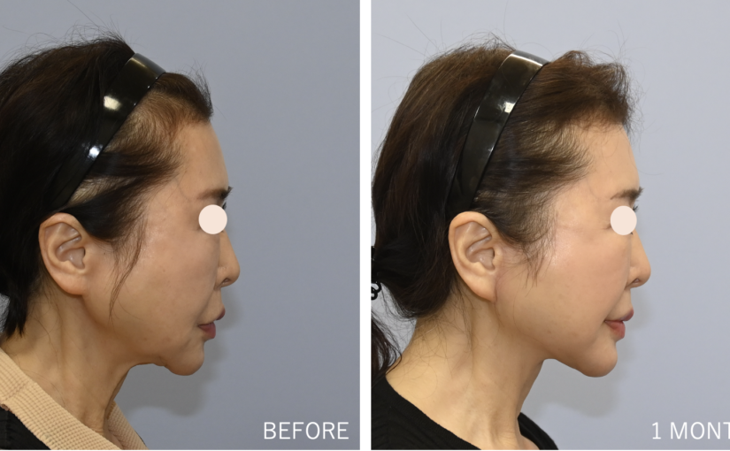 本格的な若返り【切開フェイスリフト】糸リフトでは届かない深部から、自然な若返りを｜パールスキンクリニック天神・福岡