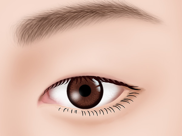 眼瞼下垂1