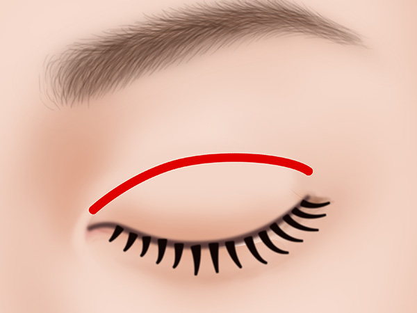 眼瞼下垂2