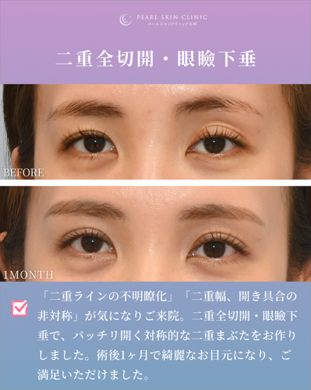 症例1 二重全切開と眼瞼下垂