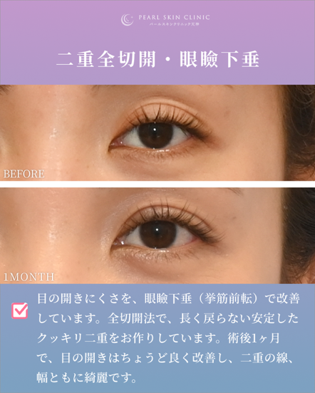 症例1 二重全切開と眼瞼下垂