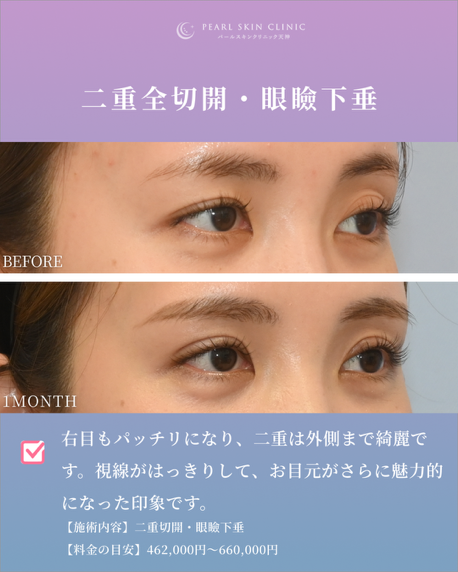 症例1 二重全切開と眼瞼下垂