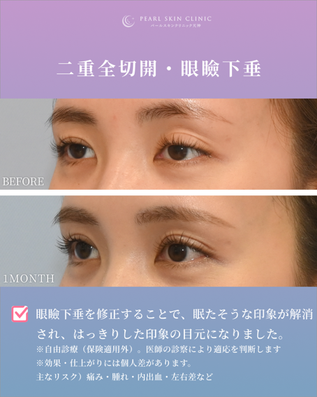 症例1 二重全切開と眼瞼下垂