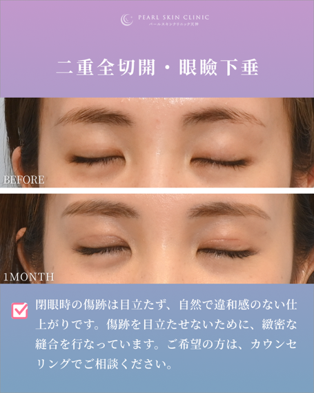 症例1 二重全切開と眼瞼下垂