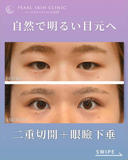 症例2 全切開と眼瞼下垂