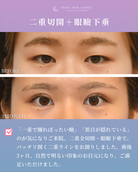 症例2 全切開と眼瞼下垂
