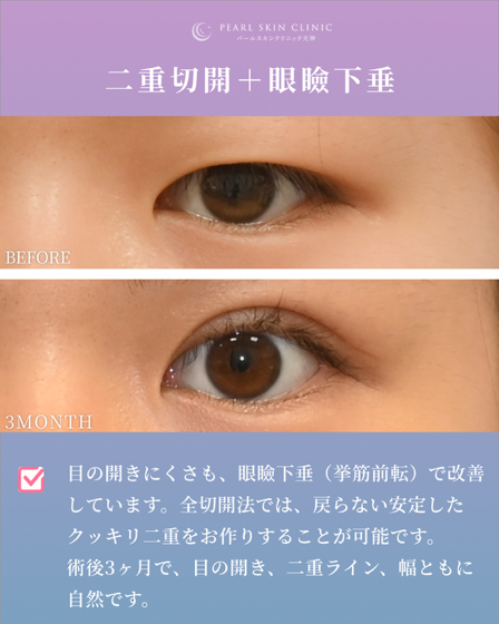 症例2 全切開と眼瞼下垂