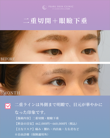 症例2 全切開と眼瞼下垂