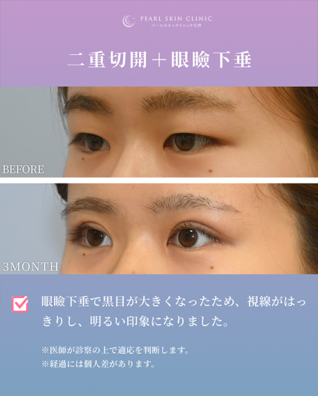 症例2 全切開と眼瞼下垂