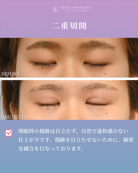 症例2 全切開と眼瞼下垂