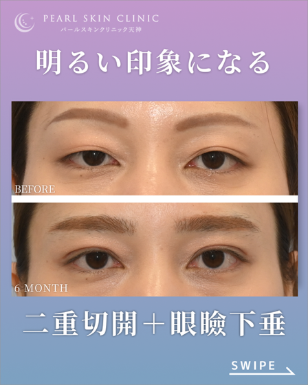 症例3 二重全切開と眼瞼下垂