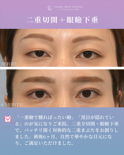 症例3 二重全切開と眼瞼下垂