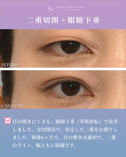 症例3 二重全切開と眼瞼下垂