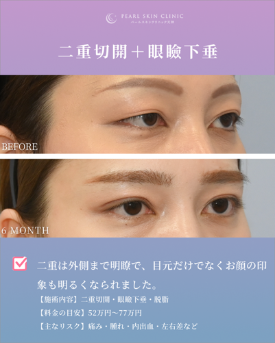 症例3 二重全切開と眼瞼下垂