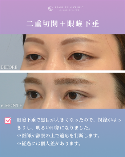 症例3 二重全切開と眼瞼下垂
