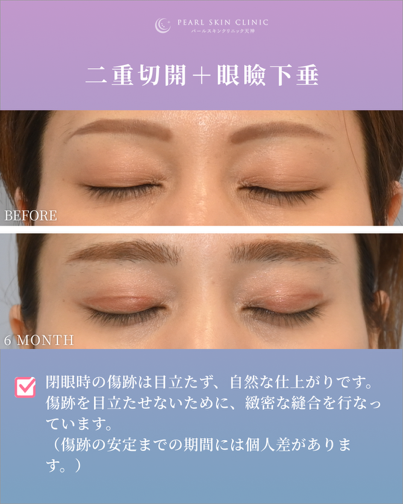 症例3 二重全切開と眼瞼下垂