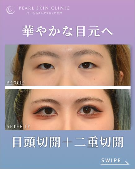 症例4 目頭切開と二重全切開と脱脂