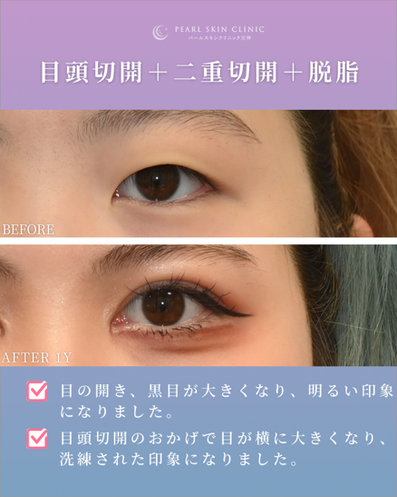 症例4 目頭切開と二重全切開と脱脂