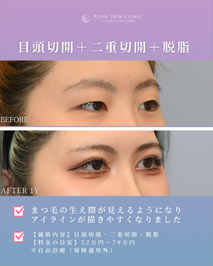 症例4 目頭切開と二重全切開と脱脂