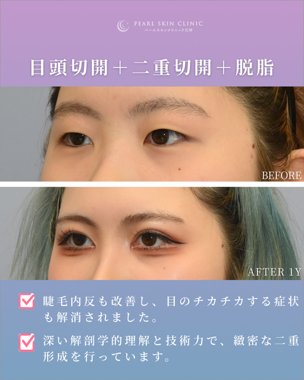 症例4 目頭切開と二重全切開と脱脂