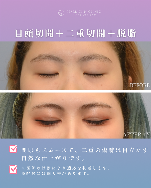 症例4 目頭切開と二重全切開と脱脂