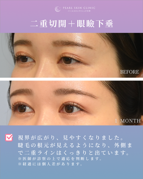 症例6 複数回の他院埋没法後の修正