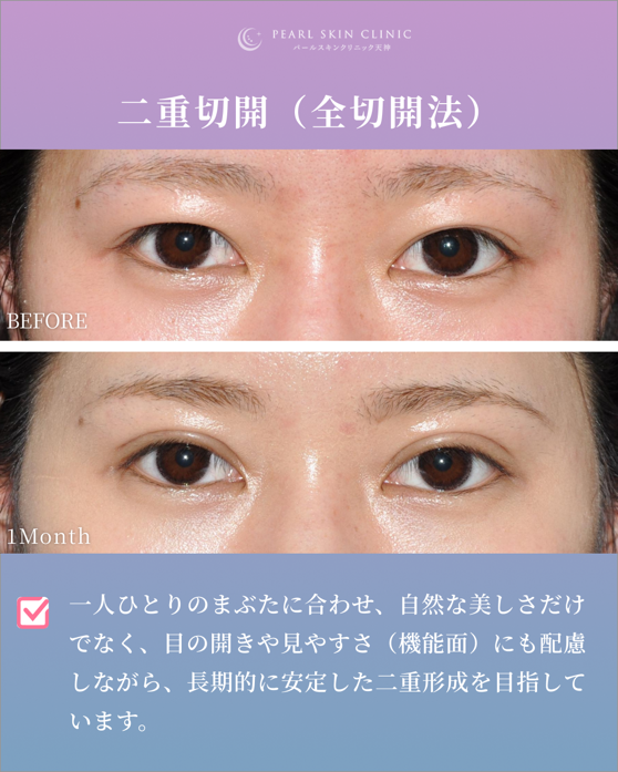 症例7 他院埋没法後の修正