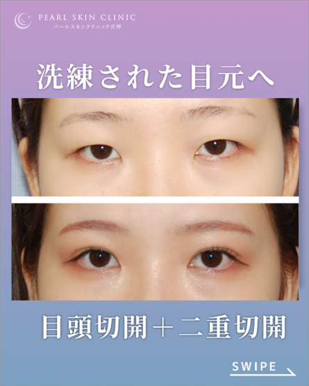症例8 目頭切開と二重全切開