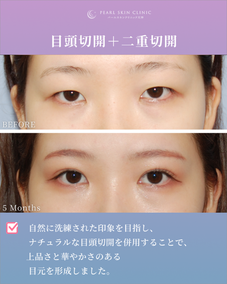 症例8 目頭切開と二重全切開