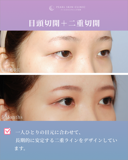 症例8 目頭切開と二重全切開