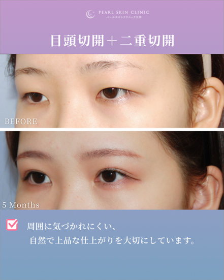 症例8 目頭切開と二重全切開