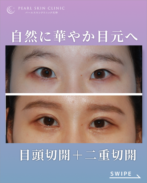 症例9 目頭切開と二重全切開