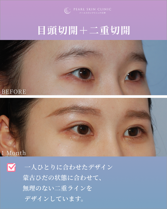 症例9 目頭切開と二重全切開